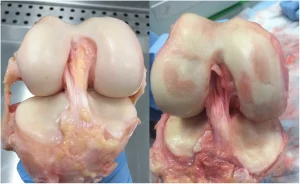 Cartilagem saudável à esquerda, lisa sem lesões. Imagem à direita mostrandrando lesões e exposição do osso abaixo da cartilagem